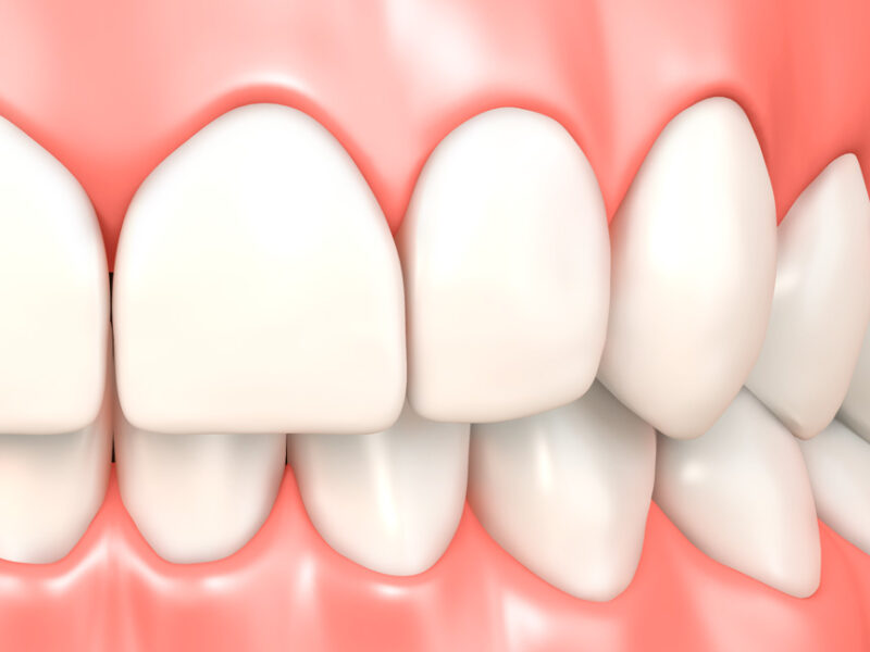 歯ぐきの健康推進